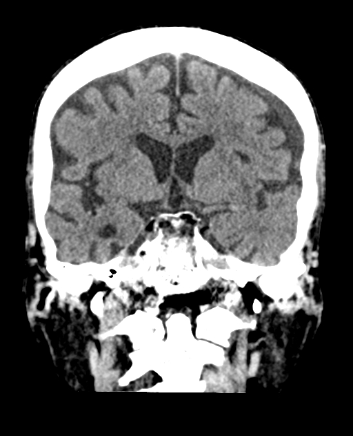 Bilateral subdural hygroma (Radiopaedia 73637-84421 Coronal non-contrast 22).jpg