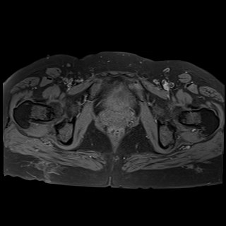 Bilateral tubo-ovarian abscesses (Radiopaedia 58635-65829 Axial T1 fat sat 38).jpg
