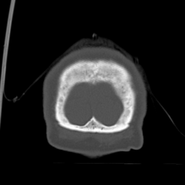 Biparietal osteodystrophy (Radiopaedia 46109-50463 Coronal bone window 101).jpg