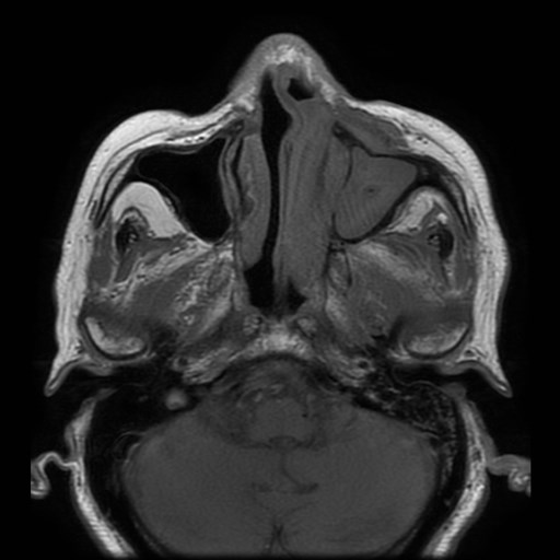 Bisphosphonate-related osteonecrosis of the maxilla (Radiopaedia 51367-57101 Axial T1 30).jpg