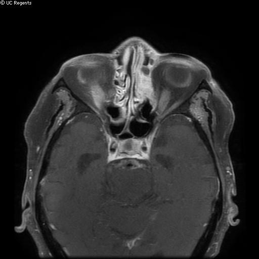 Bisphosphonate-related osteonecrosis of the maxilla (Radiopaedia 51367-57101 Axial T1 C+ fat sat 34).jpg