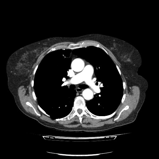 File:Bladder tumor detected on trauma CT (Radiopaedia 51809-57609 A 45).jpg