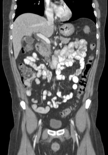 Bleeding duodenal ulcer and adenomyomatosis of gallbladder (Radiopaedia 61834-69861 B 50).jpg