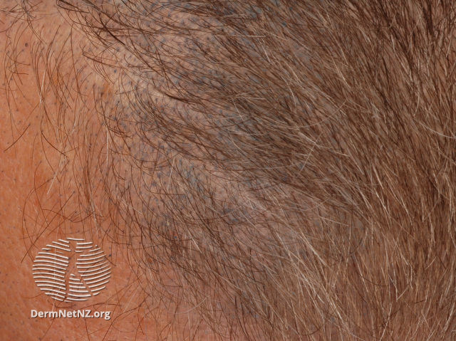 File:Blue discoloration of scalp skin (DermNet NZ apocrine-chromhidrosis-02).jpg