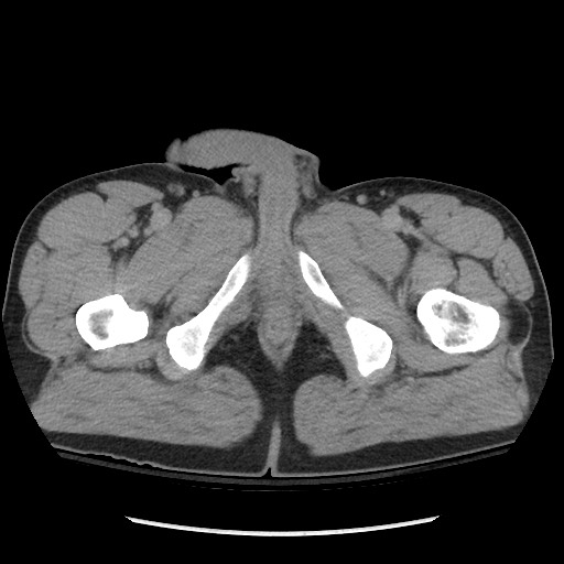 Blunt abdominal trauma with solid organ and musculoskelatal injury with active extravasation (Radiopaedia 68364-77895 Axial C+ delayed 148).jpg