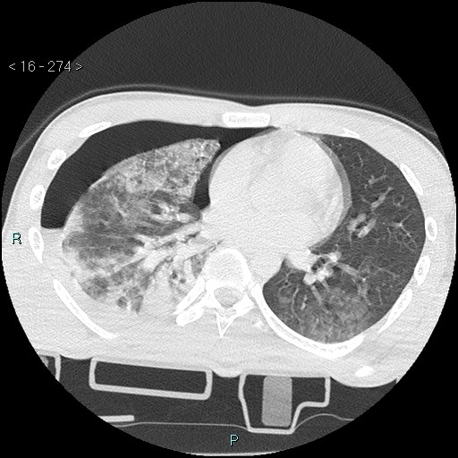 Blunt chest trauma (Swiss cheese sign) (Radiopaedia 38519-40618 Axial lung window 43).jpg