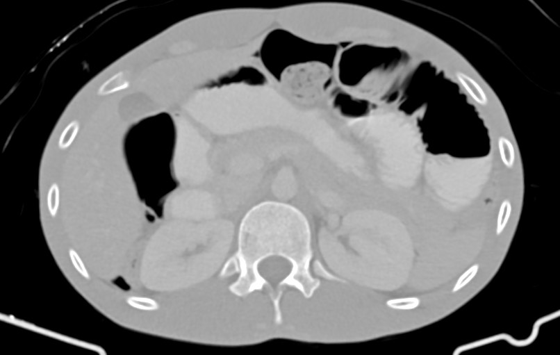 Blunt injury to the small bowel (Radiopaedia 74953-85987 Axial Wide 22).jpg