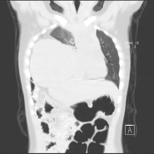 File:Bochdalek diaphragmatic hernia (Radiopaedia 38866-41059 Coronal lung window 8).jpg