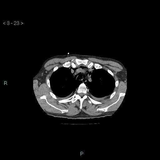 Boerhaave syndrome (Radiopaedia 27683-27897 Axial non-contrast 23).jpg
