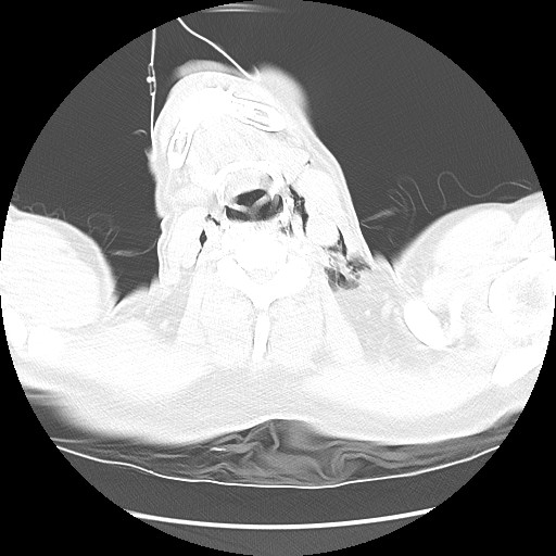 Boerhaave syndrome (Radiopaedia 59796-67310 Axial lung window 1).jpg