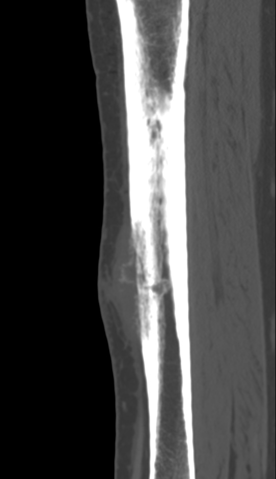 Bone metastasis - tibia (Radiopaedia 57665-64609 Sagittal bone window 93).jpg