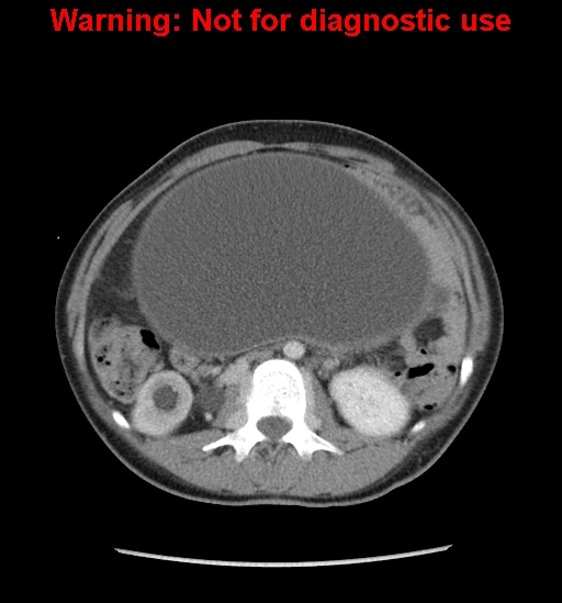 Borderline mucinous cystadenoma of ovary (Radiopaedia 25586-25767 A 17).jpg