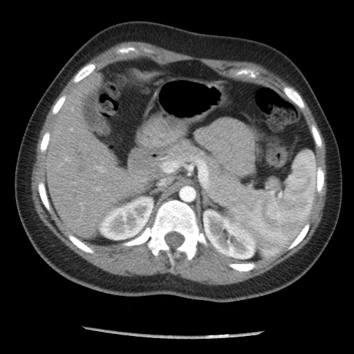 Borderline mucinous tumor (ovary) (Radiopaedia 78228-90808 A 48).jpg