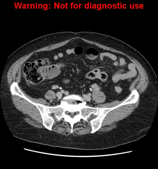 File:Bosniak renal cyst - type II (Radiopaedia 23404-23468 F 45).jpg