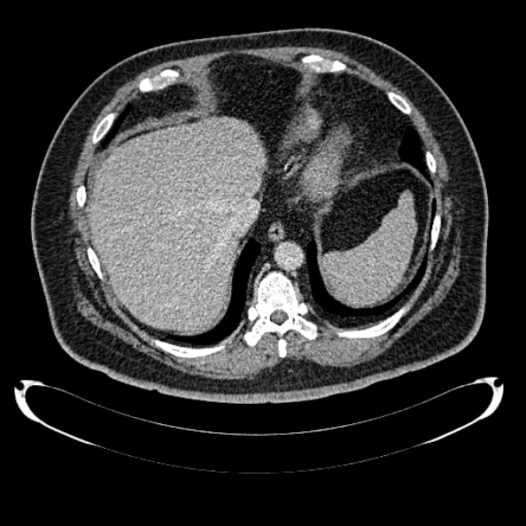 Bosniak renal cyst - type IV (Radiopaedia 24244-24518 C 29).jpg