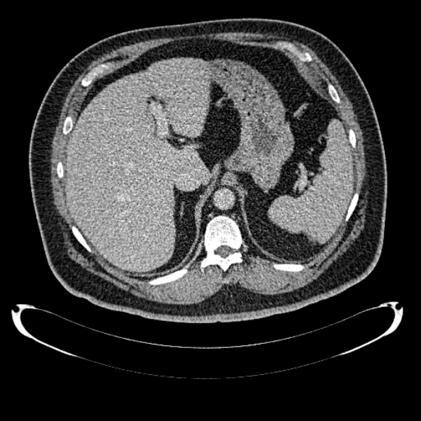 Bosniak renal cyst - type IV (Radiopaedia 24244-24518 C 62).jpg