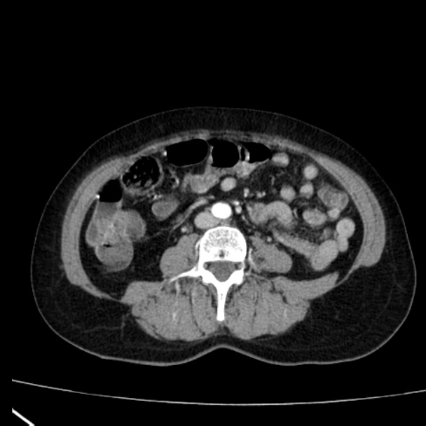 Bosniak renal cyst - type I (Radiopaedia 27479-27675 renal cortical phase 52).jpg