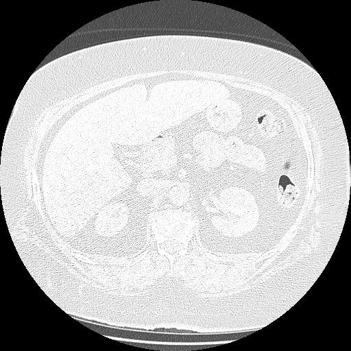 Bovine aortic arch - right internal mammary vein drains into the superior vena cava (Radiopaedia 63296-71875 Axial lung window 203).jpg
