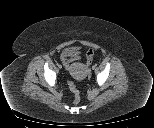 Bowel and splenic infarcts in acute lymphocytic leukemia (Radiopaedia 61055-68913 A 109).jpg