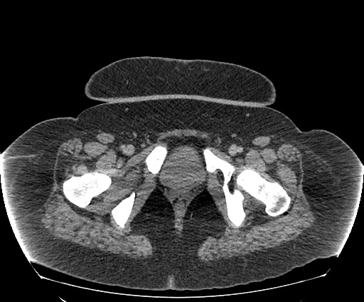 Bowel and splenic infarcts in acute lymphocytic leukemia (Radiopaedia 61055-68913 A 123).jpg
