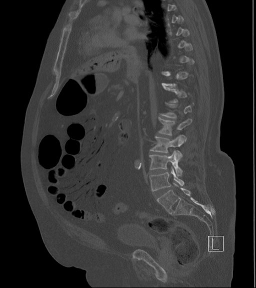 Bowel ischemia secondary to SMA occlusion with extensive portomesenteric venous gas (Radiopaedia 54656-60871 Sagittal bone window 57).jpg