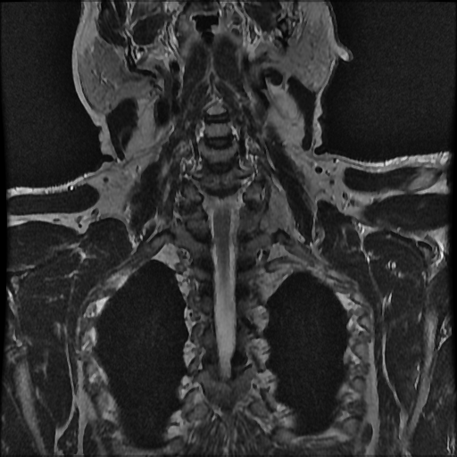 File:Brachial plexus neurofibroma (Radiopaedia 28030-28291 Coronal T2 2).png