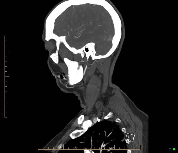Brachiocephalic trunk stenosis (Radiopaedia 87242-103519 C 53).jpg