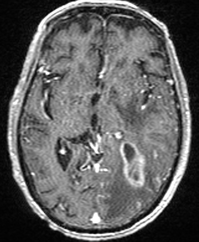 Brain abscess with dual rim sign (Radiopaedia 87566-103938 Axial T1 C+ 82).jpg