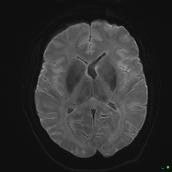 File:Brain death on MRI and CT angiography (Radiopaedia 42560-45689 Axial DWI 14).jpg