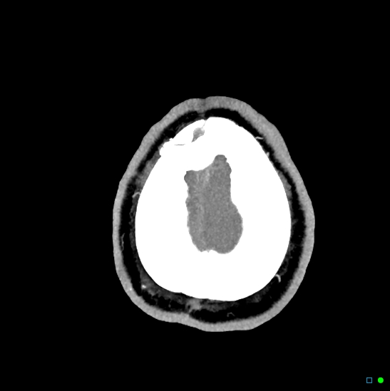 Brain death on MRI and CT angiography (Radiopaedia 42560-45841 B 5).jpg