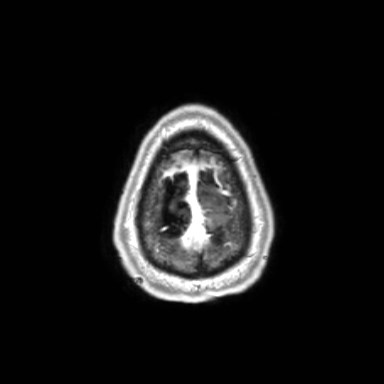 File:Brain metastases from lung cancer (Radiopaedia 83839-99028 Axial T1 C+ 66).jpg