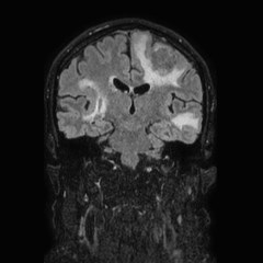 Brain metastases from lung cancer (Radiopaedia 83839-99028 Coronal FLAIR 44).jpg
