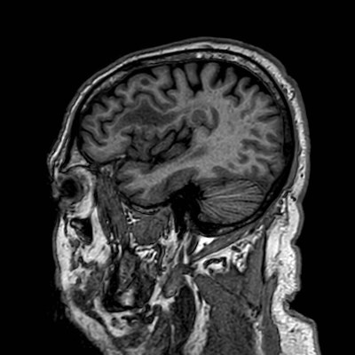 Brain metastases from lung cancer (Radiopaedia 83839-99028 Sagittal T1 26).jpg