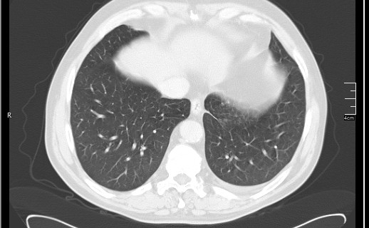 Brain metastases from squamocellular lung cancer (Radiopaedia 56515-63219 Axial lung window 50).jpg