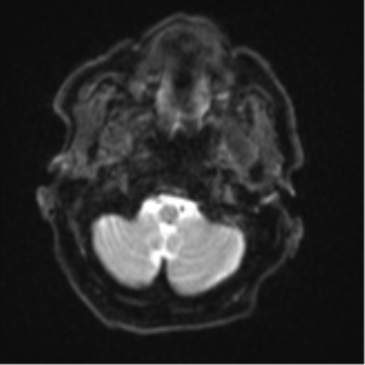 Brain metastasis (lung cancer) (Radiopaedia 48289-53179 Axial DWI 2).png