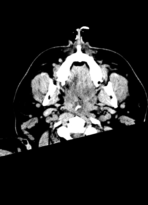 Brainstem hemorrhage (Radiopaedia 81294-94976 Axial non-contrast 72).jpg