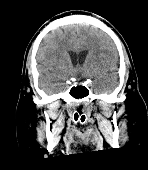 File:Brainstem hemorrhage (Radiopaedia 81294-94976 Coronal non-contrast 28).jpg