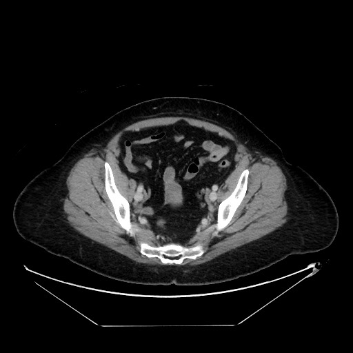 File:Breast cancer pseudocirrhosis with lobar invovlement (Radiopaedia 81080-94670 A 130).jpg