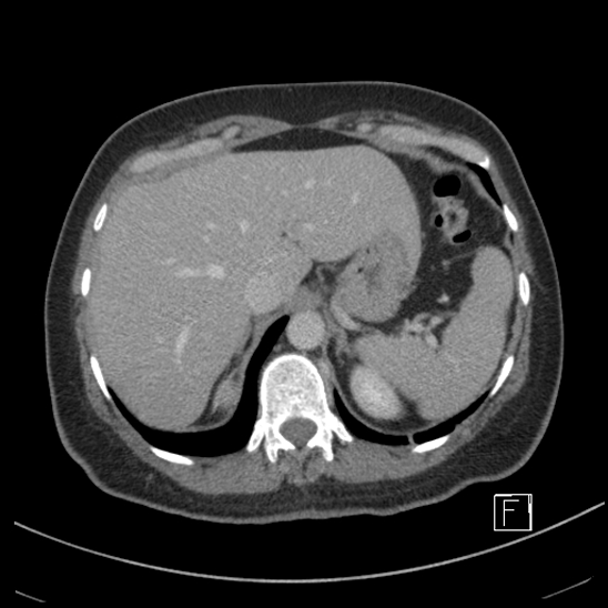 File:Breast metastases from renal cell cancer (Radiopaedia 79220-92225 C 17).jpg
