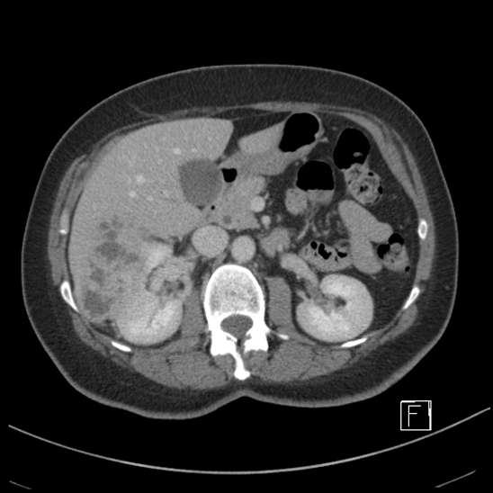 Breast metastases from renal cell cancer (Radiopaedia 79220-92225 C 36).jpg