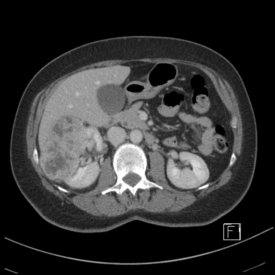 Breast metastases from renal cell cancer (Radiopaedia 79220-92225 C 39).jpg