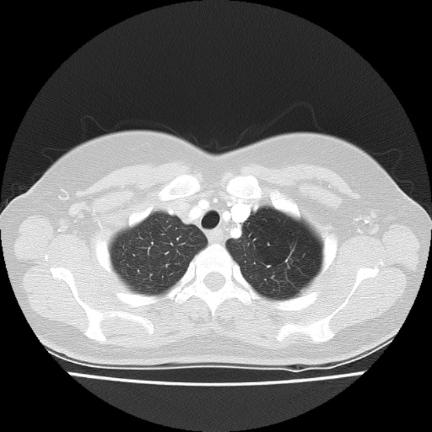 Bronchial atresia (Radiopaedia 22965-22992 Axial lung window 44).jpg