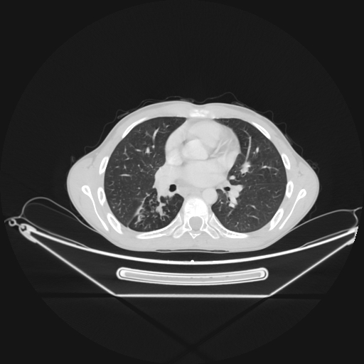 Bronchial carcinoid tumor (Radiopaedia 57187-64090 Axial lung window 39).jpg
