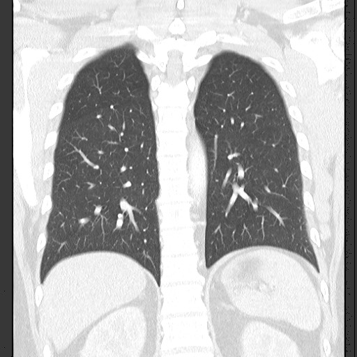 Bronchial carcinoid tumor (Radiopaedia 67377-76764 Coronal lung window 47).jpg