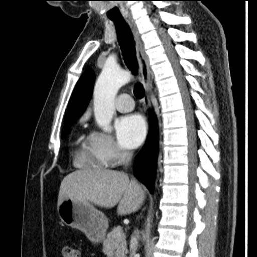 File:Bronchial carcinoid tumor (Radiopaedia 67377-76764 E 35).jpg