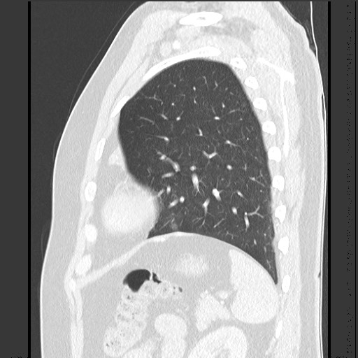 Bronchial carcinoid tumor (Radiopaedia 67377-76764 Sagittal lung window 54).jpg