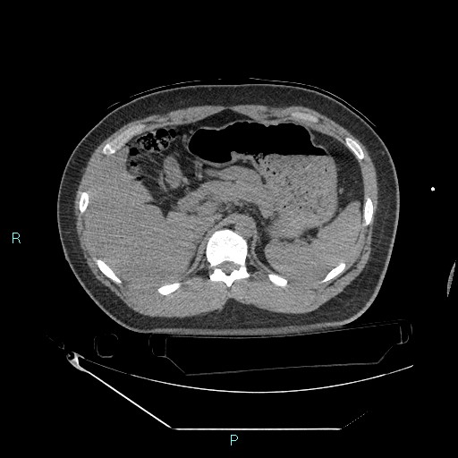 File:Bronchial carcinoid tumor (Radiopaedia 78272-90870 Axial non-contrast 110).jpg