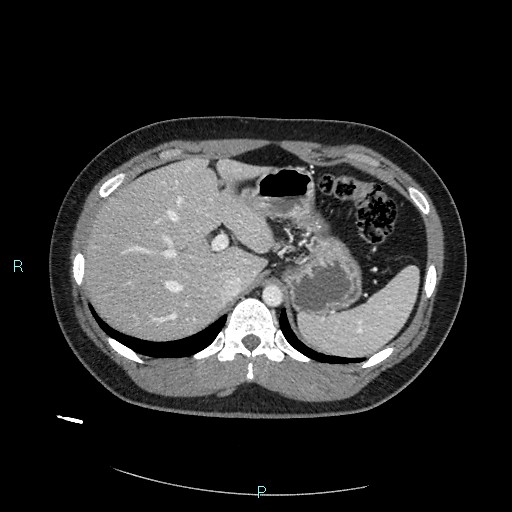 File:Bronchial carcinoid tumor (Radiopaedia 78272-90875 A 92).jpg