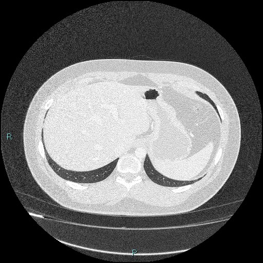 Bronchial carcinoid tumor (Radiopaedia 78272-90875 Axial lung window 49).jpg
