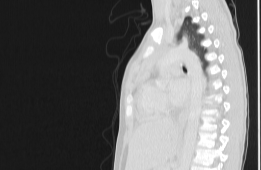 Bronchial mucoepidermoid carcinoma (Radiopaedia 57023-63895 Sagittal lung window 100).jpg
